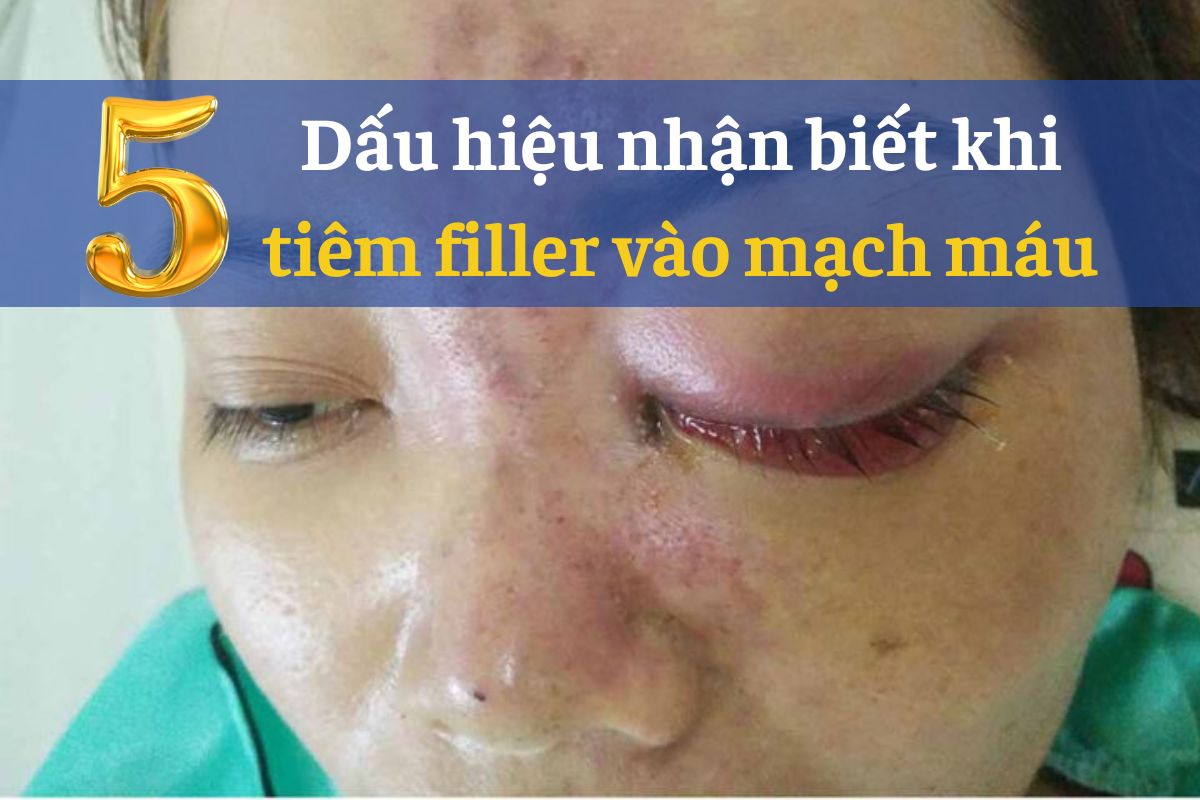 Tiêm filler vào mạch máu: Nguy hiểm và cách phòng ngừa